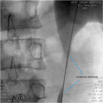 Initial Experience of Self-Expanding Metal Ureteral Stent in Recurrent Ureteral Stricture After Ureteroplasty
